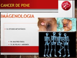 • EL ESTUDIO METASTÁSICO:
• RX (RASTRE0 ÓSEO)
• TC DE PELVIS Y ABDOMEN.
CANCER DE PENE
 