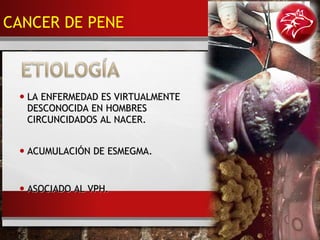 • LA ENFERMEDAD ES VIRTUALMENTELA ENFERMEDAD ES VIRTUALMENTE
DESCONOCIDA EN HOMBRESDESCONOCIDA EN HOMBRES
CIRCUNCIDADOS AL NACER.CIRCUNCIDADOS AL NACER.
• ACUMULACIÓN DE ESMEGMA.ACUMULACIÓN DE ESMEGMA.
• ASOCIADO AL VPH.ASOCIADO AL VPH.
CANCER DE PENE
 