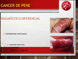 • ENFERMEDADES INFECCIOSAS:
• CHANCRO SIFILÍTICO.
• CHANCROIDE.
• CONDILOMA ACUMINADO
CANCER DE PENE
 