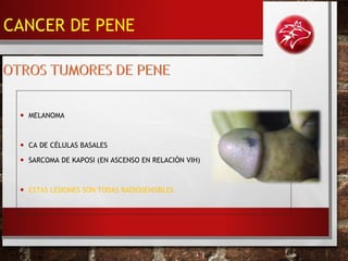 • MELANOMA
• CA DE CÉLULAS BASALES
• SARCOMA DE KAPOSI (EN ASCENSO EN RELACIÓN VIH)
• ESTAS LESIONES SON TODAS RADIOSENSIBLES
CANCER DE PENE
 