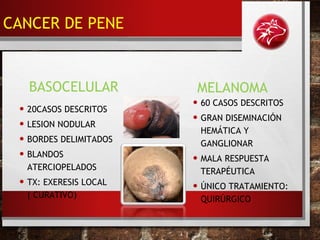 BASOCELULAR
• 20CASOS DESCRITOS
• LESION NODULAR
• BORDES DELIMITADOS
• BLANDOS
ATERCIOPELADOS
• TX: EXERESIS LOCAL
( CURATIVO)
MELANOMA
• 60 CASOS DESCRITOS
• GRAN DISEMINACIÓN
HEMÁTICA Y
GANGLIONAR
• MALA RESPUESTA
TERAPÉUTICA
• ÚNICO TRATAMIENTO:
QUIRÚRGICO
CANCER DE PENE
 