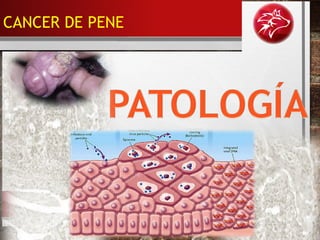 CANCER DE PENE
 