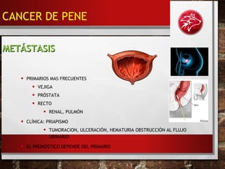 • PRIMARIOS MAS FRECUENTES
• VEJIGA
• PRÓSTATA
• RECTO
• RENAL, PULMÓN
• CLÍNICA: PRIAPISMO
• TUMORACION, ULCERACIÓN, HEMATURIA OBSTRUCCIÓN AL FLUJO
URINARIO
• EL PRONÓSTICO DEPENDE DEL PRIMARIO
METÁSTASISMETÁSTASIS
CANCER DE PENE
 