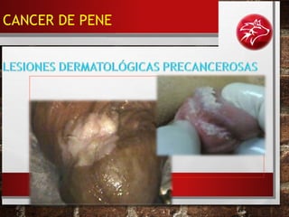 • LEUCOPLAQUIAS.
CANCER DE PENE
 