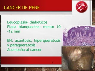 8
Leucoplasia- diabeticos
Placa blanquecina- meato 10
-12 mm
EH: acantosis, hiperqueratosis
y paraqueratosis
Acompaña al cancer
CANCER DE PENE
 