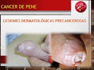 • BALANITIS XERÓTICA OBLITERANTE.
CANCER DE PENE
 