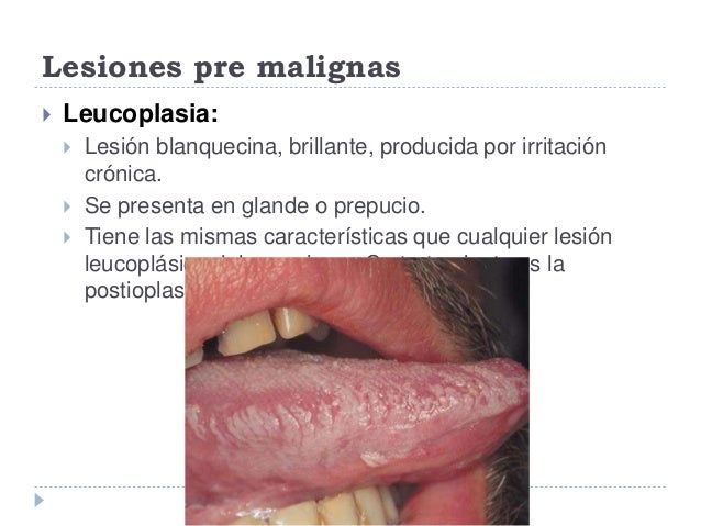 Cancer de pene Cancer de pene