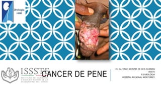 CANCER DE PENE
Dr. ALFONSO MONTES DE OCA GUZMAN
ISSSTE
R3 UROLOGIA
HOSPITAL REGIONAL MONTERREY
 