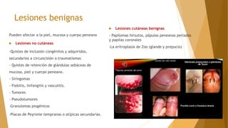 Lesiones benignas
Pueden afectar a la piel, mucosa y cuerpo peneano
 Lesiones no cutáneas
-Quistes de inclusión congénitos y adquiridos,
secundarios a circuncisión o traumatismos
- Quistes de retención de glándulas sebáceas de
mucosa, piel y cuerpo peneano.
- Siringomas
- Flebitis, linfangitis y vasculitis.
- Tumores
- Pseudotumores
-Granulomas piogénicos
-Placas de Peyronie tempranas o atípicas secundarias.
 Lesiones cutáneas benignas
- Papilomas hirsutos, pápulas peneanas perladas
y papilas coronales
-La eritroplasia de Zoo (glande y prepucio)
 