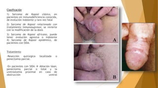 Clasificación
1) Sarcoma de Kaposi clásico, en
pacientes sin inmunodeficiencia conocida,
de evolución indolente y rara vez fatal
2) Sarcoma de Kaposi relacionado con
tratamiento inmunosupresor, se revierte
con la modificación de la dosis
3) Sarcoma de Kaposi africano, puede
tener evolución agresiva o indolente
4) Sarcoma de Kaposi epidémico, de
pacientes con SIDA.
Tratamiento
-Resección quirúrgica localizada o
penectomía parcial.
-En pacientes con SIDA  Ablación láser,
penectomía parcial o total y la
uretrostomía proximal en caso de
obstrucción uretral
 