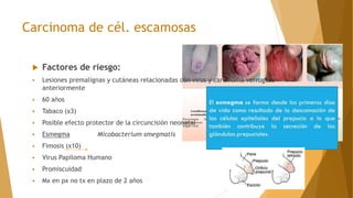 Carcinoma de cél. escamosas
 Factores de riesgo:
 Lesiones premalignas y cutáneas relacionadas con virus y carcinoma verrugoso
anteriormente
 60 años
 Tabaco (x3)
 Posible efecto protector de la circuncisión neonatal
 Esmegma Micobacterium smegmatis
 Fimosis (x10)
 Virus Papiloma Humano
 Promiscuidad
 Mx en px no tx en plazo de 2 años
 