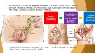  Se diseminan a través de ganglios inguinales y si estos aumentan de tamaño
conduce a necrosis cutánea, infección crónica con muerte por inanición, sepsis o
hemorragia secundaria a erosión de vasos femorales.
 Metástasis hematógenas a distancia son raras y pueden aparecer en pulmón,
hígado, hueso y cerebro, entre el 1 y 10%,
 