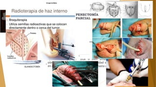 Tx de lesión primaria
 Es conservador la terapia láser, escisión local, cirugía de Mohs, crioterapia,
terapia fotodinámica, crema de 5-fluorouracilo al 5% e imiquimod tópico al
5%.
 Ta-1 G1-2 tx con láser, escisión local, radioterapia-braquiterapia y
glandectomía, con el seguimiento y vigilancia regular del paciente.
 Px se sospeche que no van a cumplir un seguimiento estrecho, o que
recidiven por segunda vez, la penectomía parcial.
 Lesiones T1G3 y T≥2 penectomía parcial, total o bien emasculación
dependiendo de la extensión de la lesión. El margen de seguridad se estima
en 2 cm, ya que un mar-gen menor se asocia a recurrencias de hasta un 32%.
 