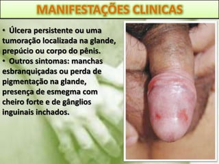 MANIFESTAÇÕES CLINICAS
• Úlcera persistente ou uma
tumoração localizada na glande,
prepúcio ou corpo do pênis.
• Outros sintomas: manchas
esbranquiçadas ou perda de
pigmentação na glande,
presença de esmegma com
cheiro forte e de gânglios
inguinais inchados.
 