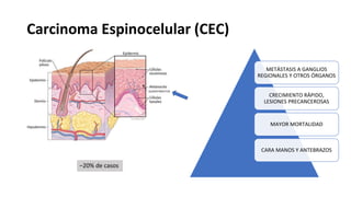 Carcinoma Espinocelular (CEC)
METÁSTASIS A GANGLIOS
REGIONALES Y OTROS ÓRGANOS
CRECIMIENTO RÁPIDO,
LESIONES PRECANCEROSAS
MAYOR MORTALIDAD
CARA MANOS Y ANTEBRAZOS
QUERATINOCITOS
–20% de casos
 