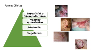 Formas Clínicas
Superficial o
intraepidérmico..
Nodular
queratósico
Ulcerada.
Vegetante..
 