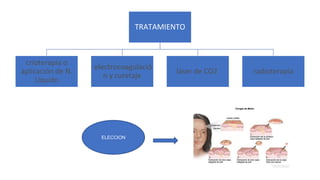 TRATAMIENTO
crioterapia o
aplicación de N.
Líquido
electrocoagulació
n y curetaje
láser de CO2 radioterapia
electrocoagulació
n y curetaje
láser de CO2
ELECCION
 