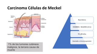 Carcinoma Células de Meckel
Raza blanca
HOMBRES - MUJERES (14:1)
70 y 80 años
Asociado a inmunosupresion
1% de los tumores cutáneos
malignos, la tercera causa de
muerte
 