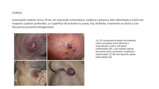 CLINICA
tumoración nodular única, firme, de coloración eritematosa, violácea o púrpura, bien delimitada y móvil con
respecto a planos profundos. La superficie de la lesión es suave, lisa, brillante, raramente se ulcera y con
frecuencia presenta telangiectasia
A). En ocasiones la lesión se presenta
como una placa única dérmica o
subcutánea o como una placa
multinodular (B), y de manera menos
frecuente como una lesión multifocal o
diseminada ( C) Se han descrito casos
pediculados (D)
 