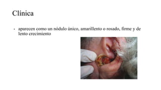Clínica
• aparecen como un nódulo único, amarillento o rosado, firme y de
lento crecimiento
 