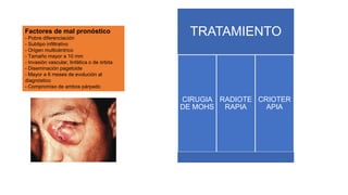 TRATAMIENTO
CIRUGIA
DE MOHS
RADIOTE
RAPIA
CRIOTER
APIA
Factores de mal pronóstico
- Pobre diferenciación
- Subtipo infiltrativo
- Origen multicéntrico
- Tamaño mayor a 10 mm
- Invasión vascular, linfática o de órbita
- Diseminación pagetoide
- Mayor a 6 meses de evolución al
diagnóstico
- Compromiso de ambos párpado
 
