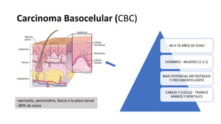 Carcinoma Basocelular (CBC)
40 A 79 AÑOS DE EDAD
HOMBRES - MUJERES (1.5:1)
BAJO POTENCIAL METASTÁSICO
Y CRECIMIENTO LENTO
CABEZA Y CUELLO - TRONCO
MANOS Y GENITALES
–periostio, pericondrio, fascia o la placa tarsal
–80% de casos
 