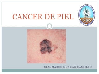 CANCER DE PIEL




       GIANMARCO GUZMAN CASTILLO
 