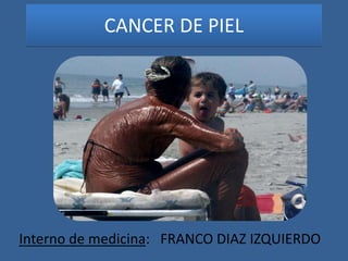 CANCER DE PIEL
Interno de medicina: FRANCO DIAZ IZQUIERDO
 