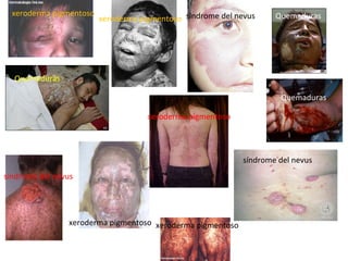 xeroderma pigmentoso

xeroderma pigmentoso síndrome del nevus

Quemaduras

Quemaduras
Quemaduras
xeroderma pigmentoso

síndrome del nevus
síndrome del nevus

Quemaduras
xeroderma pigmentoso xeroderma pigmentoso

 