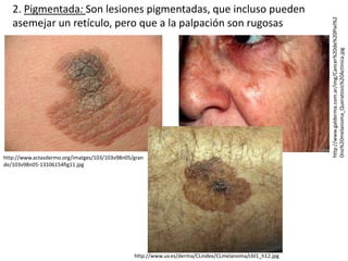 Clidex Cancer de piel | PPTX