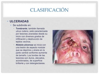 Ulcus Rodems Cancer de piel presentación digital para exponer | PPTX