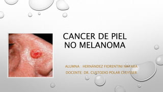 CANCER DE PIEL
NO MELANOMA
ALUMNA : HERNÁNDEZ FIORENTINI NAYARA
DOCENTE: DR. CUSTODIO POLAR CLEYSSER
 