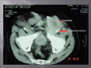 femoral artery tumour 
