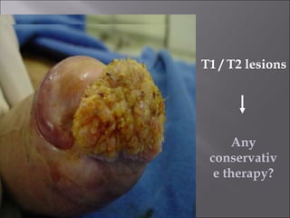 T1 / T2 lesions Any conservative therapy? 