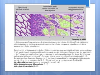 1. Células pequeñas y uniformes. 2 Más espacio entre las células. 3 Infiltración de células no
glandulares en la periferia. 4 Masas irregulares de células con pocas glandulares. 5 No se
presencian células glandulares.

Está basado en la apariencia de las células cancerosas, que son clasificadas en una escala de
1 a 5 (ver imagen). La puntuación es la suma de los dos patrones más comunes, por ejemplo, 3
+ 4 = 7, el primero es el patrón más común, por la tanto no es lo mismo 3 + 4 que 4 + 3 aunque
aritméticamente sea lo mismo (7). Tambien puede haber un solo patron por ejemplo 3 + 3.
En resumen, hay 5 grados Gleason con 9 puntuaciones posibles, la menor puntuación puede
ser de 2 (1 + 1) y la mayor es de 10 (5 + 5) que a su vez se agruparan en GI, GII y GIII.
GI o Bien diferenciado (con una puntuación entre 2 y 4)
GII o Moderadamente diferenciado (5 - 7)
GIII o Mal diferenciado (8 -10)
 