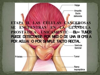 ETAPA II. LAS CÉLULAS CANCEROSAS
SE ENCUENTRAN EN LA GLÁNDULA
PROSTÁTICA ÚNICAMENTE. EL TUMOR
PUEDE DETECTARSE POR MEDI O DE UNA BI OPSI A
POR AGUJA, O POR SI MPLE TACTO RECTAL.
 