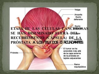 ETAPA III. LAS CÉLULAS CANCEROSAS
SE HAN DISEMINADO FUERA DEL
RECUBRIMIENTO (CÁPSULA) DE LA
PRÓSTATA A LOS TEJI DOS CI RCUNDANTES.
 