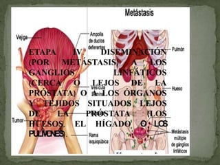 ETAPA IV. DISEMINACIÓN
(POR METÁSTASIS) A LOS
GANGLIOS LINFÁTICOS
(CERCA O LEJOS DE LA
PRÓSTATA) O A LOS ÓRGANOS
Y TEJIDOS SITUADOS LEJOS
DE LA PRÓSTATA (LOS
HUESOS, EL HÍGADO O LOS
PULMONES).
 