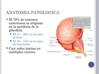 ANATOMIA PATOLOGICA
 El 70% de tumores
cancerosos se originan
en la periferia de la
glándula
 El 15 – 20% en la zona
central
 El 10 – 15% en la zona
de transición
 Casi todos inician en
múltiples centros
 