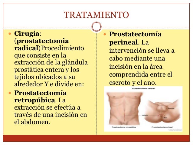 L Arginina Y Cancer De Prostata | sintomas enfermedad de L Arginina Y Cancer De Prostata | sintomas enfermedad de
