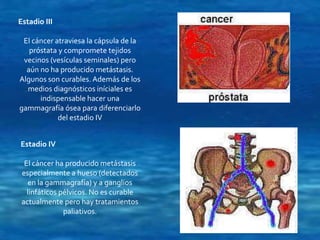 Estadio III 
El cáncer atraviesa la cápsula de la 
próstata y compromete tejidos 
vecinos (vesículas seminales) pero 
aún no ha producido metástasis. 
Algunos son curables. Además de los 
medios diagnósticos iníciales es 
indispensable hacer una 
gammagrafía ósea para diferenciarlo 
del estadio IV 
Estadio IV 
El cáncer ha producido metástasis 
especialmente a hueso (detectados 
en la gammagrafía) y a ganglios 
linfáticos pélvicos. No es curable 
actualmente pero hay tratamientos 
paliativos. 
 