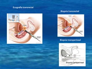 Ecografía transrectal 
Biopsia transrectal 
Biopsia transperineal 
 