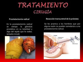Prostatectomía radical 
En la prostatectomía radical 
se extirpa la glándula 
prostática en su totalidad y 
algo del tejido que le rodea. 
(estadio inicial) 
Resección transuretral de la próstata 
Se les practica a los hombres que por 
alguna razón no pueden someterse a una 
prostatectomía radical. 
 