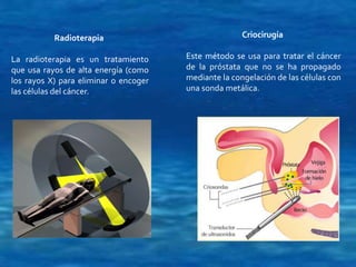 Radioterapia 
La radioterapia es un tratamiento 
que usa rayos de alta energía (como 
los rayos X) para eliminar o encoger 
las células del cáncer. 
Criocirugía 
Este método se usa para tratar el cáncer 
de la próstata que no se ha propagado 
mediante la congelación de las células con 
una sonda metálica. 
 