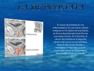 El cáncer de próstata es una 
enfermedad en la cual crecen células 
malignas en los tejidos de la próstata, 
en forma desordenada hasta formar 
una masa o tumor. En Colombia, el 
cáncer de próstata es el segundo 
cáncer más común en los hombres, 
después del cáncer de piel, y 
representa la segunda causa de 
muerte por cáncer en los hombres, 
después del cáncer de pulmón. 
 