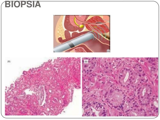 Cancer de prostata Cancer de prostata