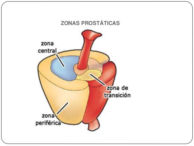 Cancer de prostata Cancer de prostata
