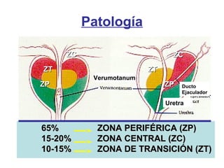 Verumotanum
Ducto
Ejaculador
Uretra
ZPZP ZPZP
ZTZT ZTZT
ZCZC ZCZC
65%65% ZONA PERIFÉRICA (ZP)ZONA PERIFÉRICA (ZP)
15-20%15-20% ZONA CENTRAL (ZC)ZONA CENTRAL (ZC)
10-15%10-15% ZONA DE TRANSICIÓN (ZT)ZONA DE TRANSICIÓN (ZT)
Patología
 