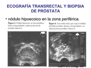 ECOGRAFÍA TRANSRECTAL Y BIOPSIA
DE PRÓSTATA
• nódulo hipoecoico en la zona periférica.
Goto Y. Int J. Urology 1998Goto Y. Int J. Urology 1998
 