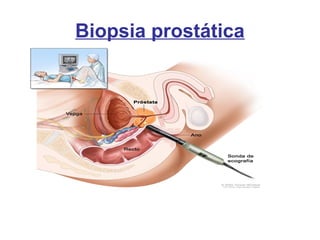 Biopsia prostática
 